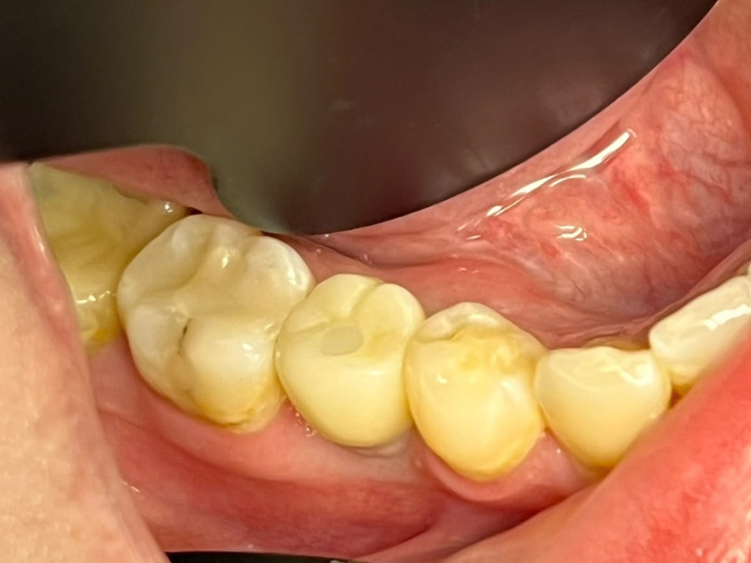 Dental implant procedure step 5 – final placement of the permanent crown Smile Centrum