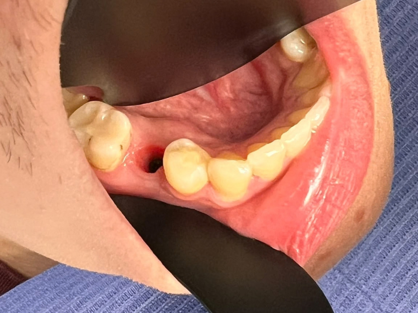 Имплантация зубов шаг 1 – подготовка костного ложа в десне Smile Centrum