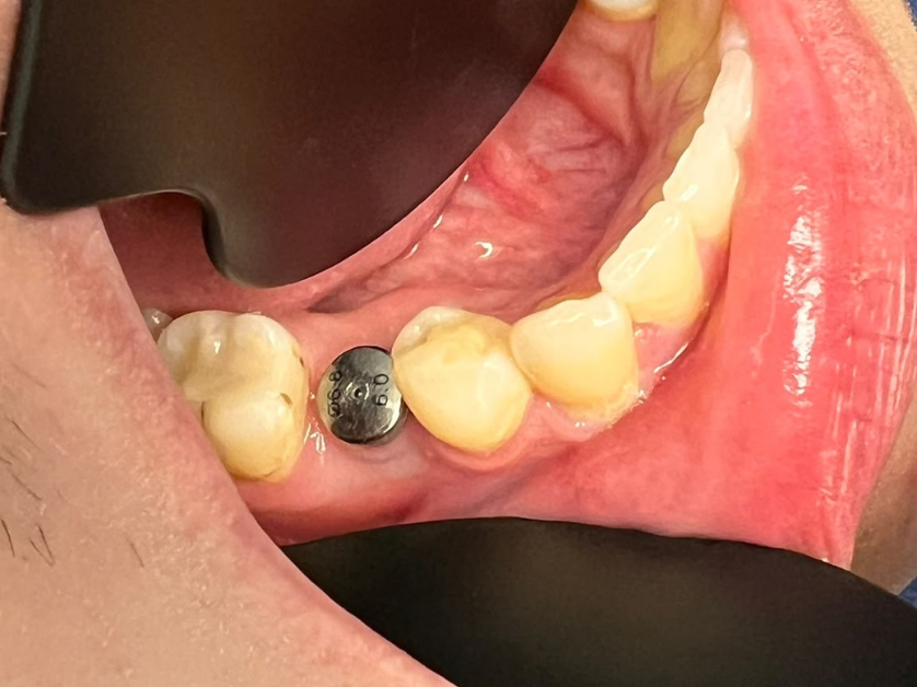 Zavedení zubního implantátu krok 2 – zavedení implantátu
