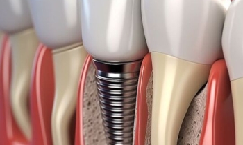 Zubní implantát jako náhrada chybějícího zubu
