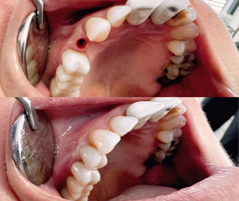 Zubní implantáty před a po