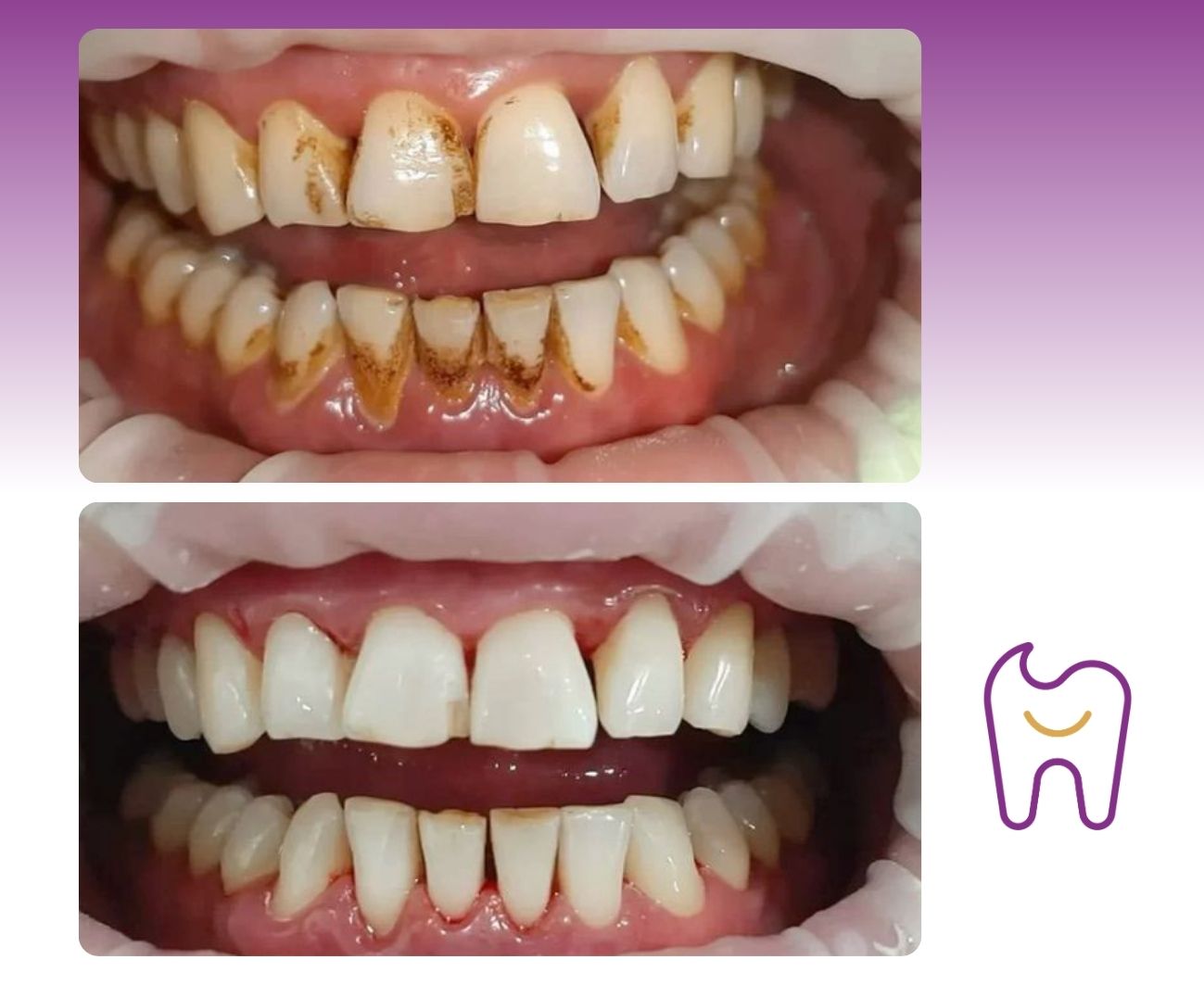 Profesionální dentální hygiena