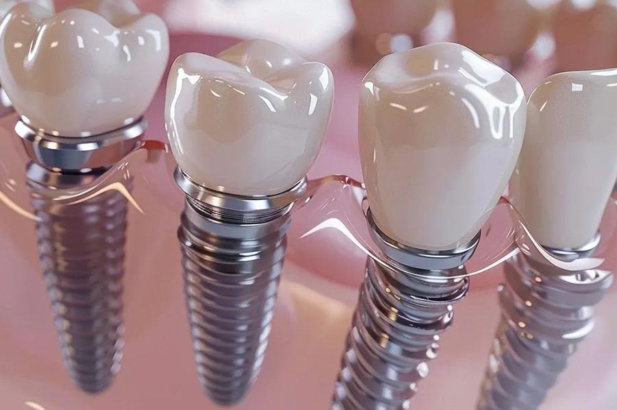 Zubní implantáty
