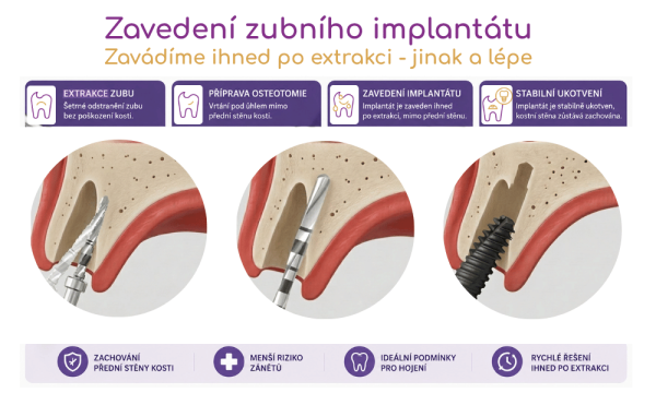 Zavedení implantátů
